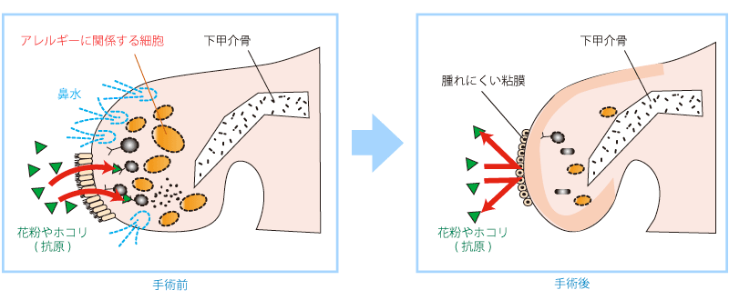 アレルギー性鼻炎・高周波ラジオ波を用いた手術